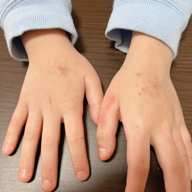「自傷をやめたいのにやめられない」自分と相手の気持ちを理解することの大切さ